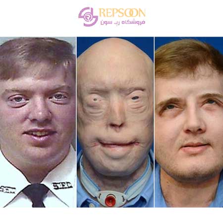 The-biggest-face-transplant-to-an-American-firefighter-min